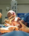 Cesarean section birth
