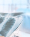 chest xray