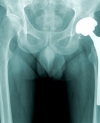 Variations exist in the volume of hip and knee replacement procedures among hospitals that participated in a Medicare bundled payment program, but the program was not was responsible for those variations, researchers say.